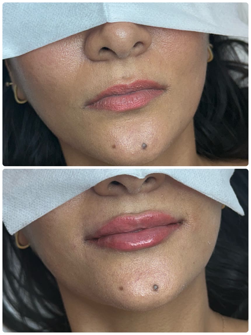 Lip filler before and after — Dr. Belove result