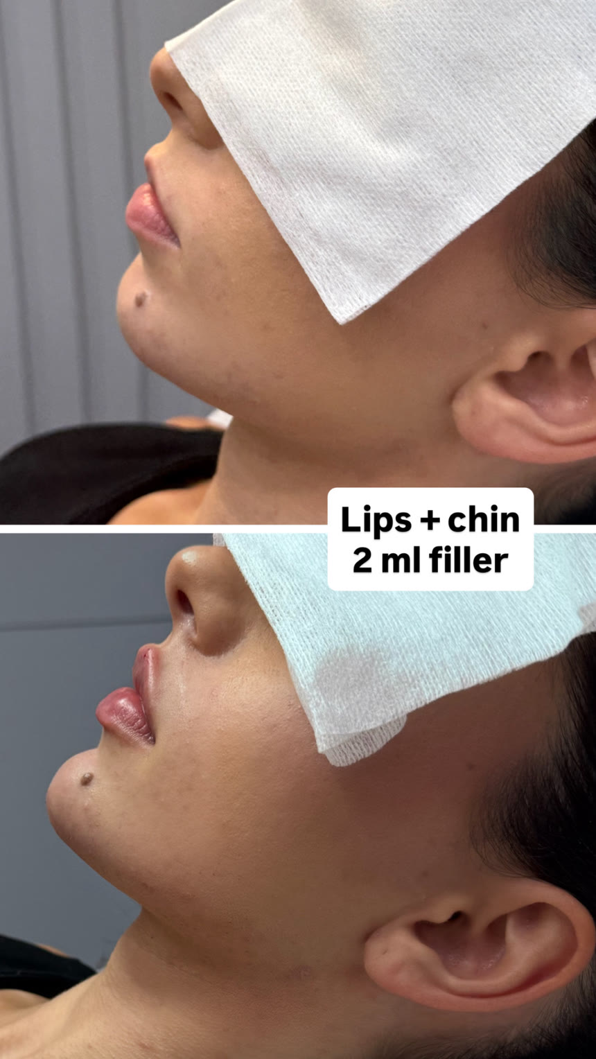 Lip filler before and after — Dr. Belove result