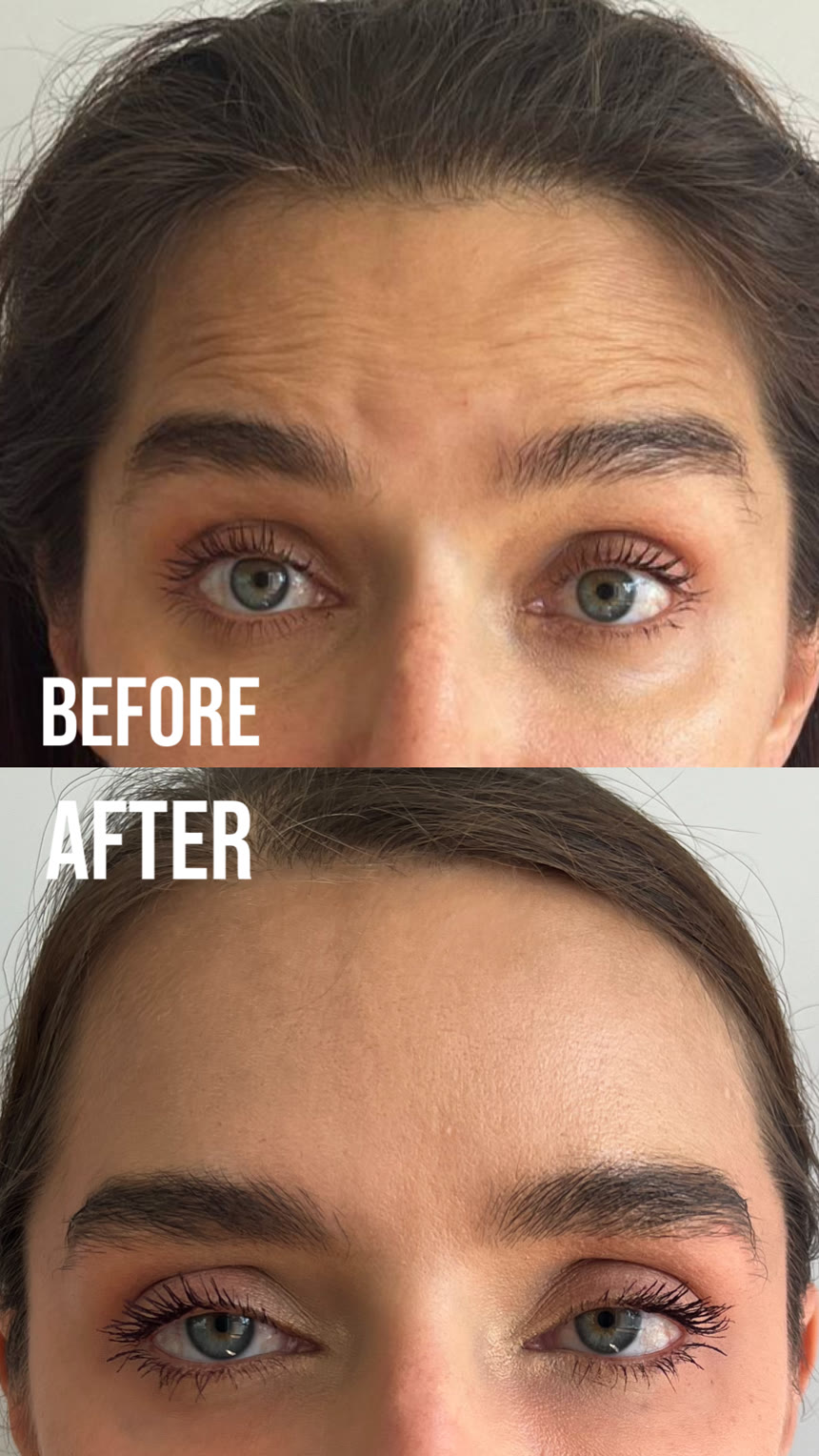 Botox before and after — Dr. Belove result
