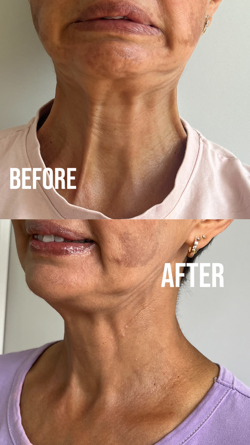 Botox before and after — Dr. Belove result